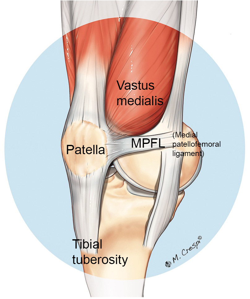 recurrent-patellar-dislocation-orthosport-victoria