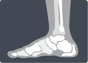 Ankle Arthroscopy | OrthoSport Victoria