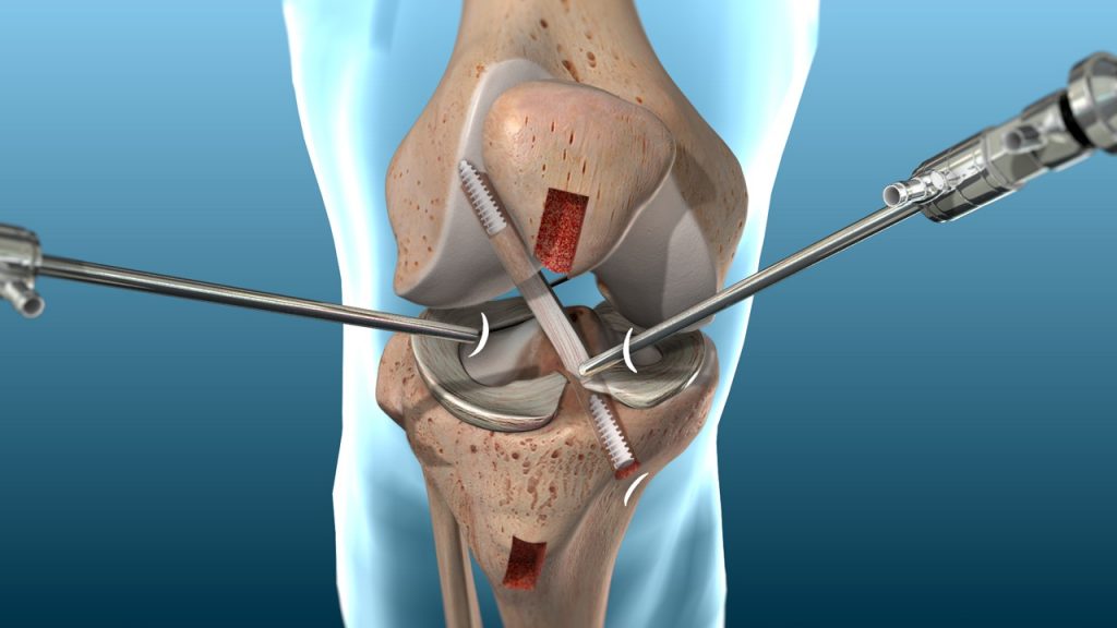 An illustration showing the ACL reconstruction procedure